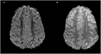 Trajectory of Long-Term Outcome in Severe Pediatric Diffuse Axonal Injury: An Exploratory Study